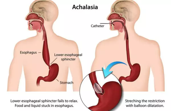Akalasia (achalasia) adalah penyakit langka yang merujuk pada kelainan di kerongkongan. Penderita akalasia akan sulit menelan makanan dan minuman