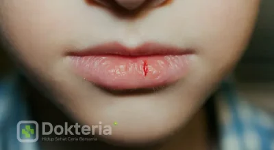 Cara Mengatasi Bibir Kering dan Pecah-Pecah
