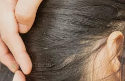 Obat Kutu Rambut pada Anak yang Aman dan Efektif