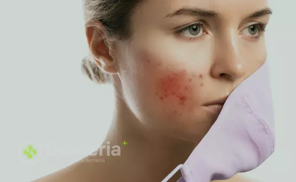 Solusi Ampuh dan Efektif Mengatasi Jerawat