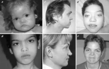 Aase Smith Syndrome
