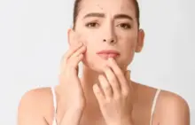 Cara Menghilangkan Bekas Jerawat dengan Bahan Alami dan Treatment Terkini