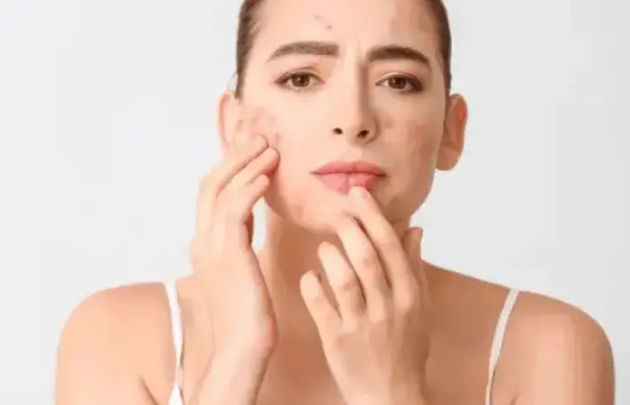 Cara Menghilangkan Bekas Jerawat dengan Bahan Alami dan Treatment Terkini