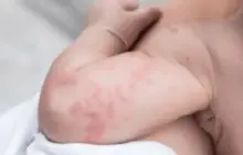 Efek Samping Vaksin Campak MR, Ringan tapi Wajib Diwaspadai