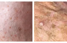 Aktinik Keratosis
