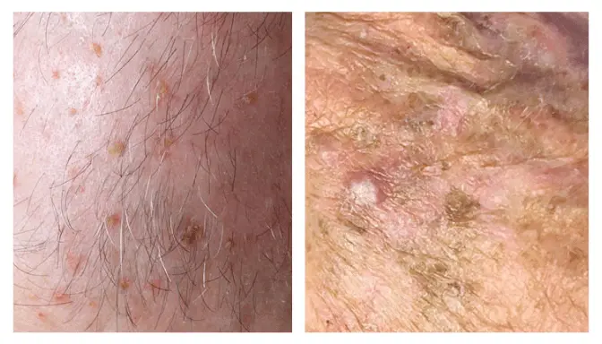 Aktinik Keratosis - Penyakit Kulit Akibat Paparan Sinar Matahari