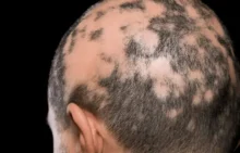 Alopecia Areata