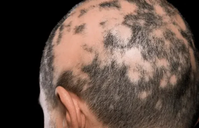 Alopecia Areata Adalah Kebotakan Autoimun, Ini Faktanya