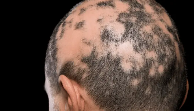 Alopecia Areata 4 Alopecia Areata Adalah Kebotakan Autoimun, Ini Faktanya