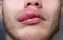 Angioedema