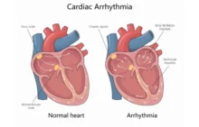 Aritmia