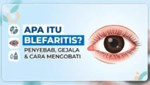 Blefaritis
