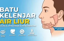 Batu Kelenjar Air Liur