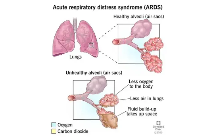 Mengenal ARDS Acute Respiratory Distress Syndrome (ARDS), Kondisi Gawat Darurat pada Paru-Paru