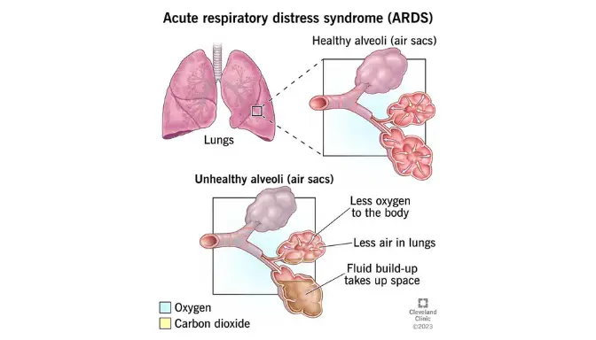 Acute Respiratory Distress Syndrome (ARDS) 3 Mengenal ARDS Acute Respiratory Distress Syndrome (ARDS), Kondisi Gawat Darurat pada Paru-Paru