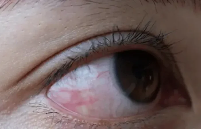 Mengenal Ablasi Retina, Saat Retina Mata Terlepas dari Tempatnya