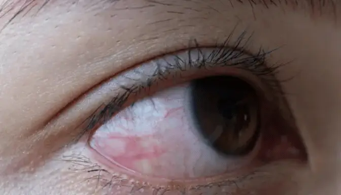 Ablasi Retina 2 Mengenal Ablasi Retina, Saat Retina Mata Terlepas dari Tempatnya
