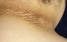 Acanthosis Nigricans