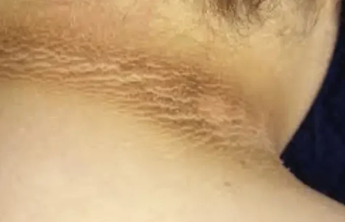 Mengenal Acanthosis Nigricans pada Leher dan Ketiak