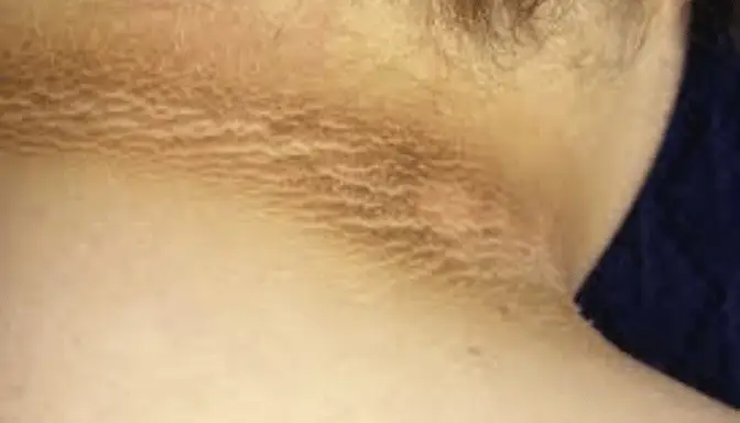 Mengenal Acanthosis Nigricans pada Leher dan Ketiak