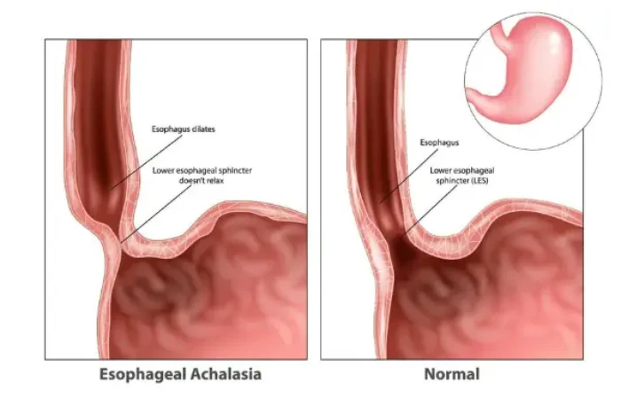 Mengenal Achalasia, Penyebab Sulit Menelan Makanan
