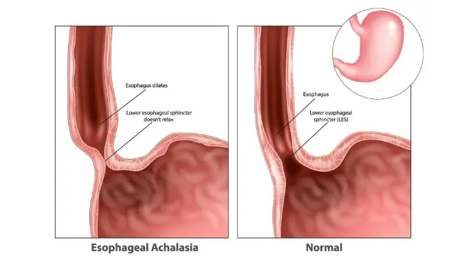 Mengenal Achalasia, Penyebab Sulit Menelan Makanan