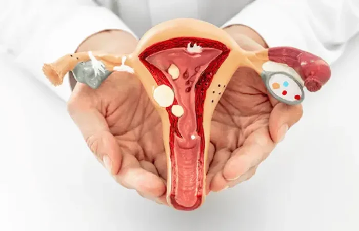 Mengenal Adenomiosis pada Rahim, Tanda dan Pengobatan