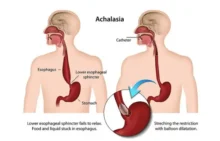 Akalasia