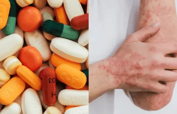 Mengenal Alergi Obat dan Reaksi yang Perlu Diwaspadai