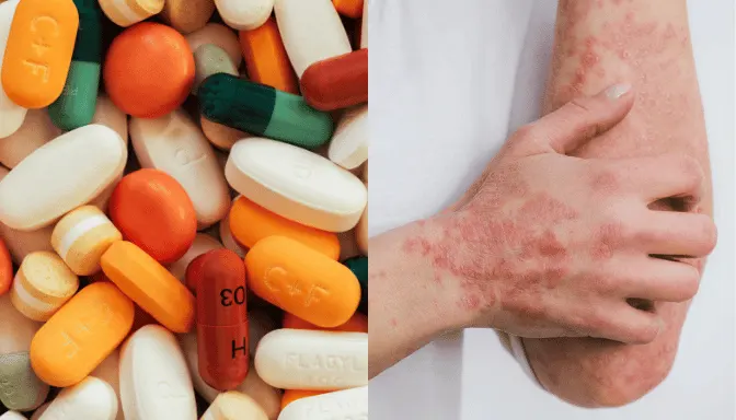 Alergi Obat 7 Mengenal Alergi Obat dan Reaksi yang Perlu Diwaspadai