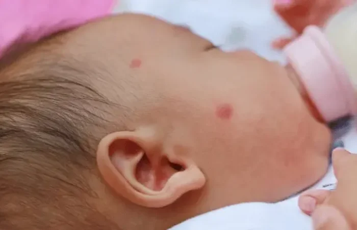 Mengenal Alergi Susu - Penyebab, Diagnosis, dan Terapi
