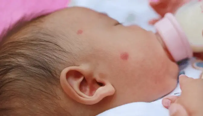 Alergi Susu 6 Mengenal Alergi Susu - Penyebab, Diagnosis, dan Terapi