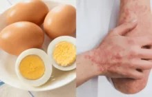 Alergi Telur