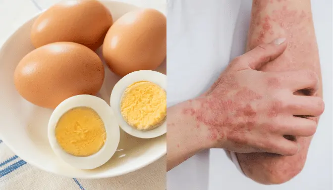 Alergi Telur 5 Mengenal Alergi Telur - Penyebab, Diagnosis, dan Pencegahan