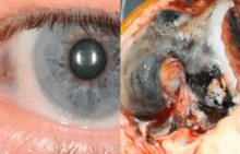 Alkaptonuria