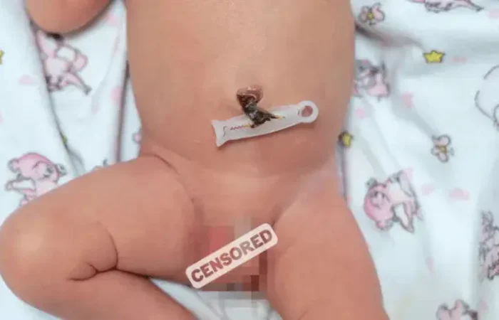 Mengenal Ambiguous Genitalia dan Cara Penanganannya