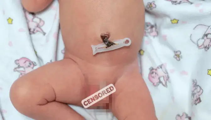 Mengenal Ambiguous Genitalia dan Cara Penanganannya