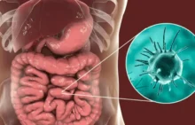 Amebiasis