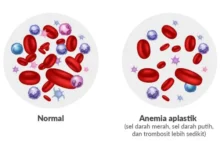 Anemia Aplastik