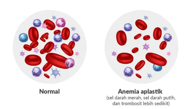 Anemia Aplastik 4 Mengenal Anemia Aplastik dan Dampaknya pada Tubuh