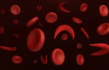 Anemia Sel Sabit