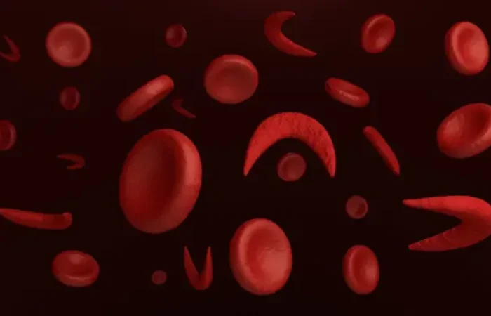 Mengenal Anemia Sel Sabit, Kelainan Darah Genetik yang Serius