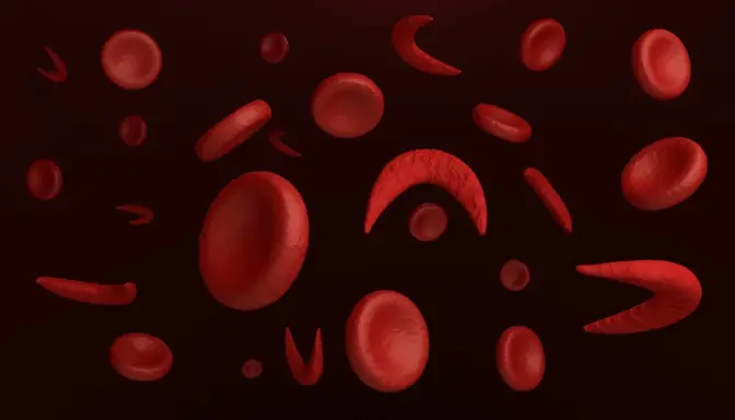 Anemia Sel Sabit 2 Mengenal Anemia Sel Sabit, Kelainan Darah Genetik yang Serius