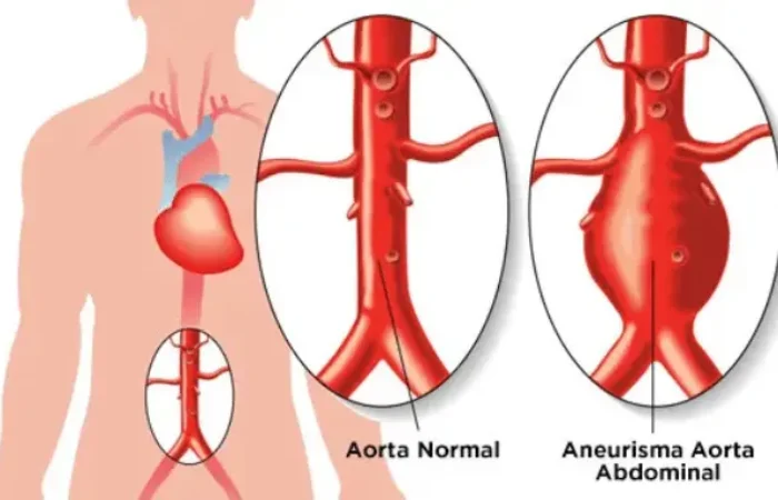 Aneurisma Aorta Abdominalis