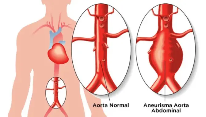 Aneurisma Aorta Abdominalis 4 Mengenal Aneurisma Aorta Abdominalis yang Bisa Mengancam Jiwa