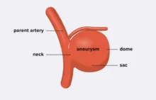 Aneurisma Berry