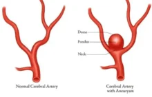 Aneurisma