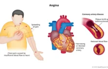 Angina Pektoris