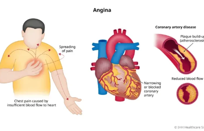 Mengenal Angina Pektoris, Nyeri Dada Akibat Penyakit Jantung