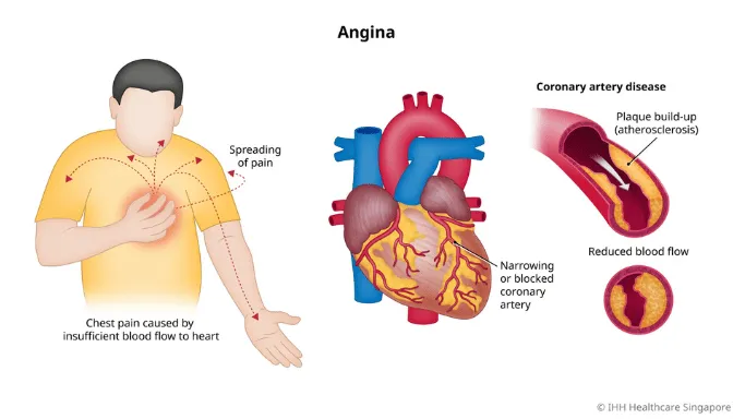 Angina Pektoris 2 Mengenal Angina Pektoris, Nyeri Dada Akibat Penyakit Jantung